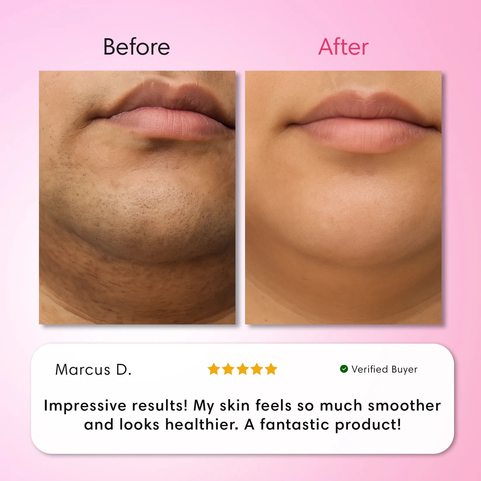 Cyperus™ Hair Removal Kit