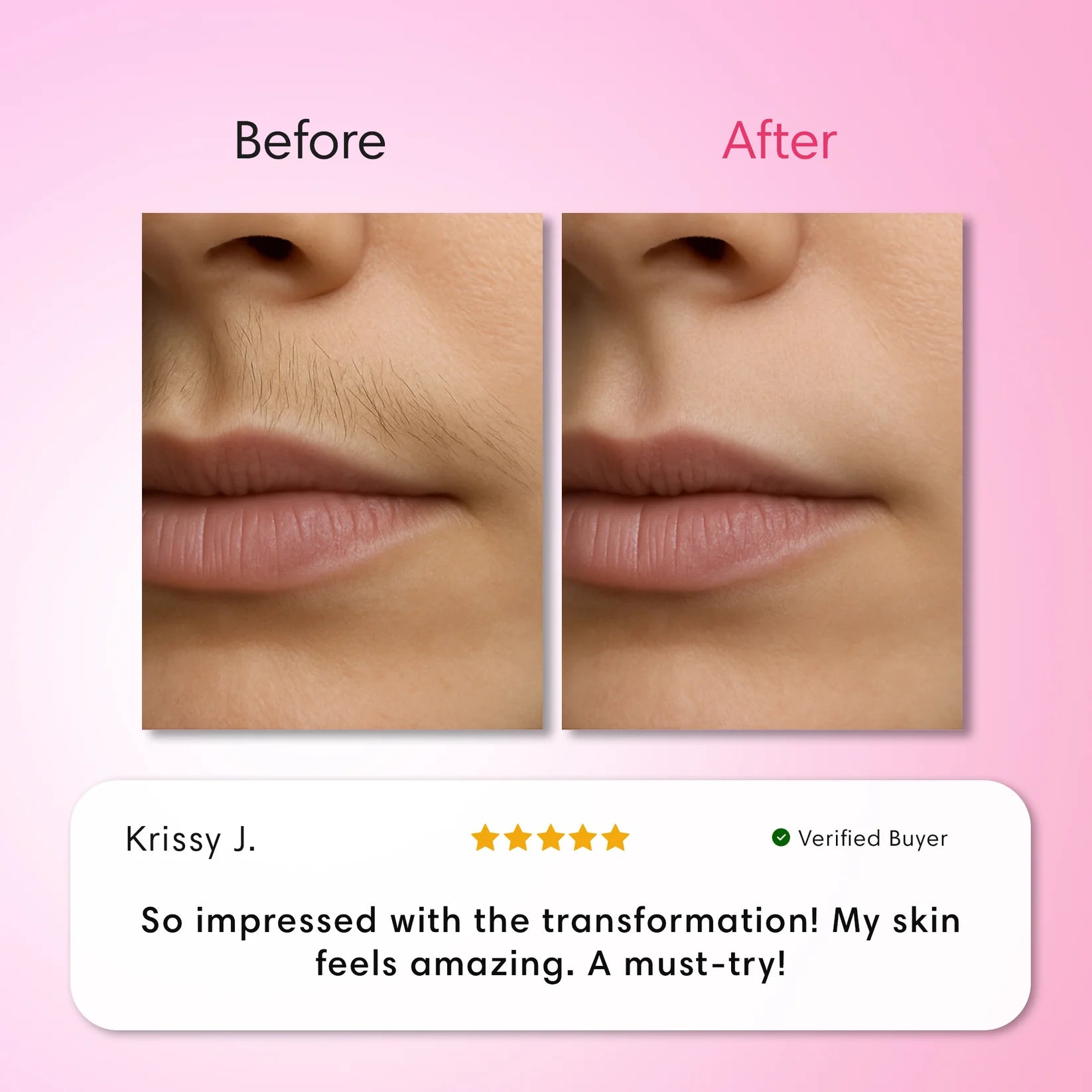 Cyperus™ Hair Removal Kit