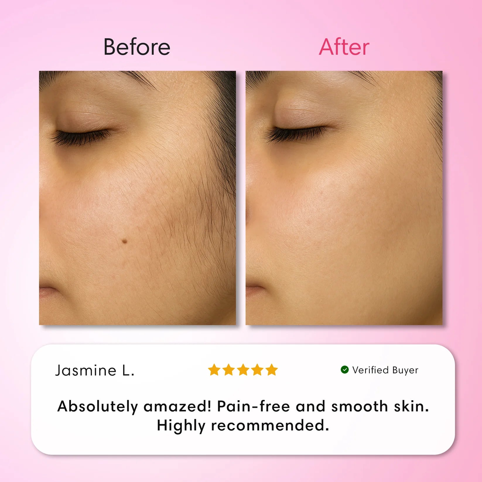 Cyperus™ Hair Removal Kit